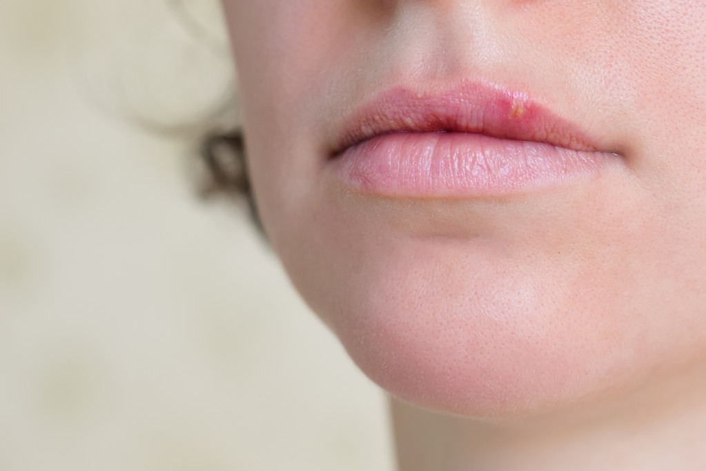 實用 | 讓你遠離撕裂的痛——8個天然護唇法請收好！