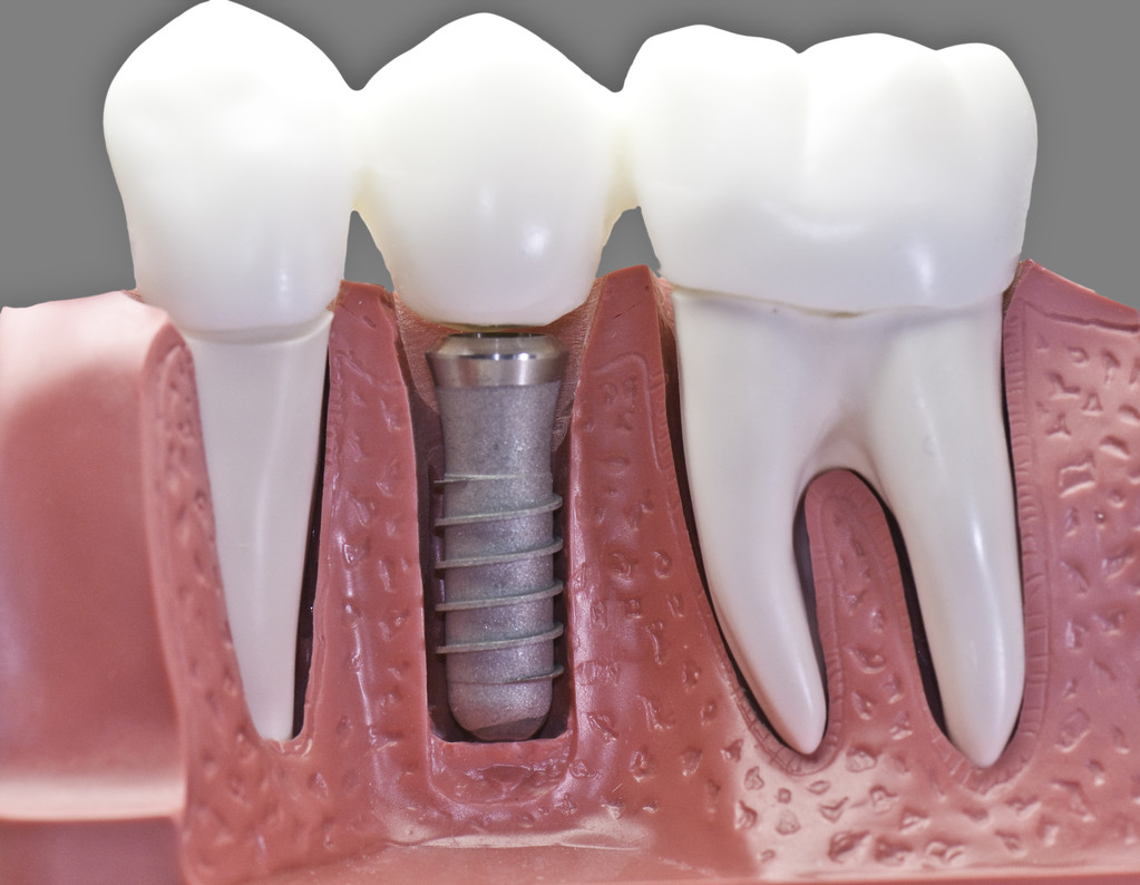 鑲牙前 口腔內的殘根如何處理？