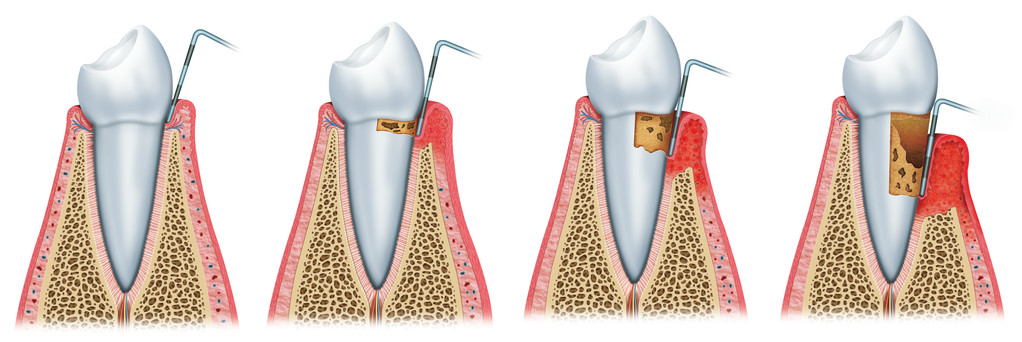 你的牙齒有越來越長的趨勢嗎？小心牙齦萎縮找上你！