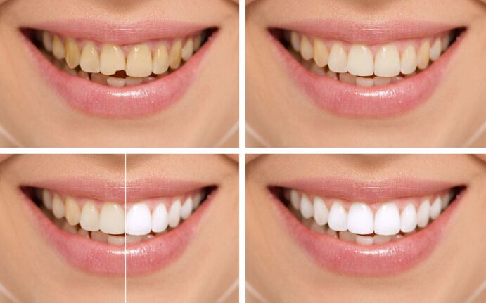 有效天然牙齒美白方法