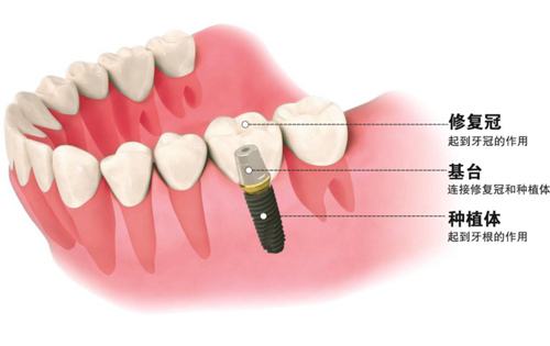 種植牙發展過程