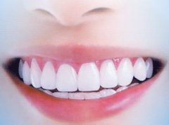 牙齒美白可以維持幾耐?