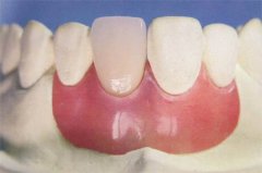 牙齒固定修復後遺症同埋解決方法?