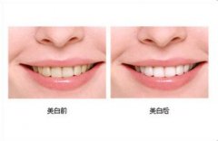 用牙齒美白劑進行牙齒美白適合乜？