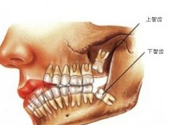 智齒到底要唔要拔?智齒唔拔危害