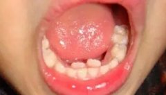 家長至想了解嘅11個兒童牙病問題