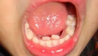 兒童牙病問題