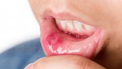 口腔潰瘍病因及口腔潰瘍治療