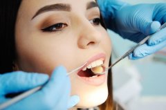 剝牙後出血點算？牙科專家教你應對措施
