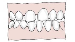 牙齒稀疏原因有邊D？
