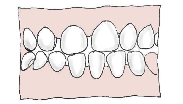 牙齒稀疏原因