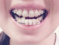 牙齒唔齊會引起疾病咩？