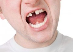 牙齒缺失原因系乜？