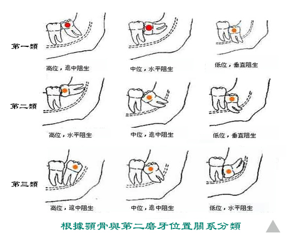 拔牙影響記憶