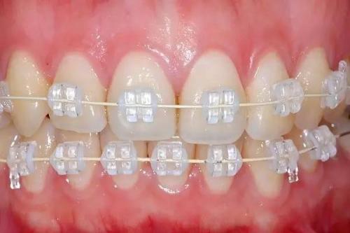 深圳箍牙,箍牙過程