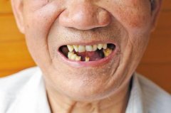 深圳做種牙需要多久？