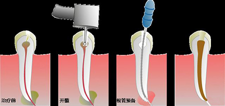 杜牙根後牙齒會鬆動咩?