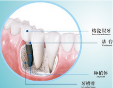 多顆牙缺失有乜危害？