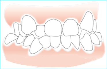 深圳牙齒矯正注意事項