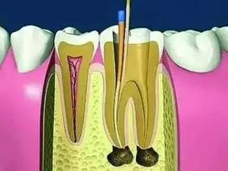 深圳根管治療