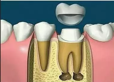 深圳根管治療