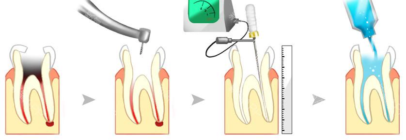 深圳根管治療