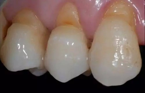 深圳鍥狀缺損補牙幾錢？