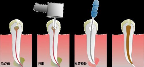 深圳牙痛做根管治療大概要幾錢？