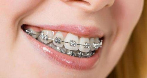 隱形箍牙優勢有邊啲?隱形箍牙同傳統矯正區別喺邊度?
