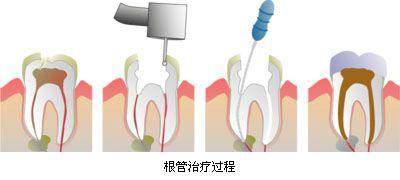 深圳羅湖根管治療系點樣