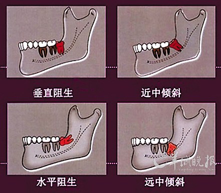 深圳拔智齒需要幾錢