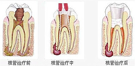 做了杜牙根后牙齒嘅壽命點樣