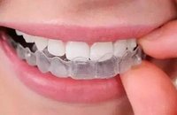 隱形箍牙收費系幾多？