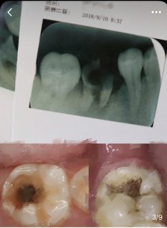 牙痛和根管治療距離需要種植治療有多遠？