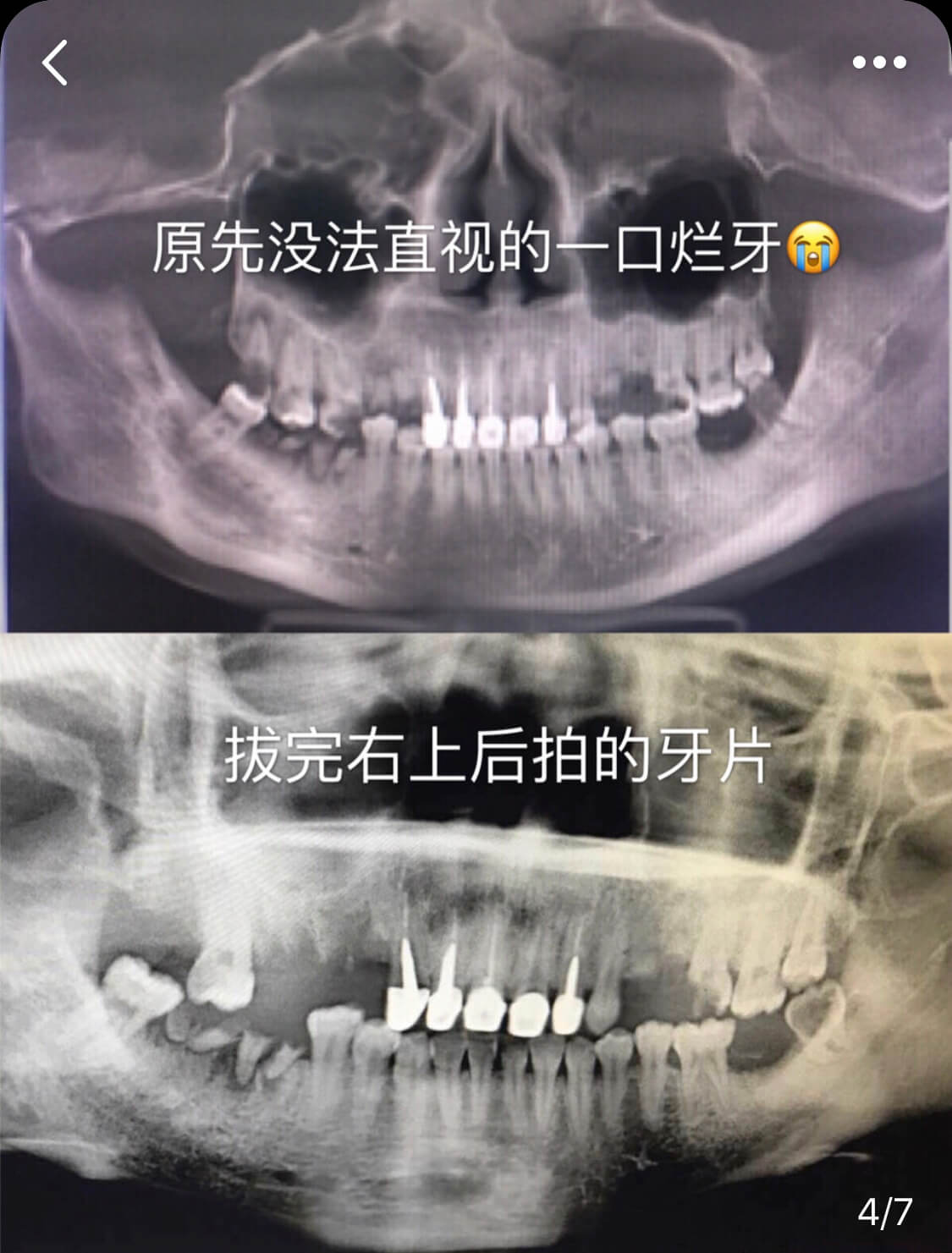 烤瓷牙會唔會斷