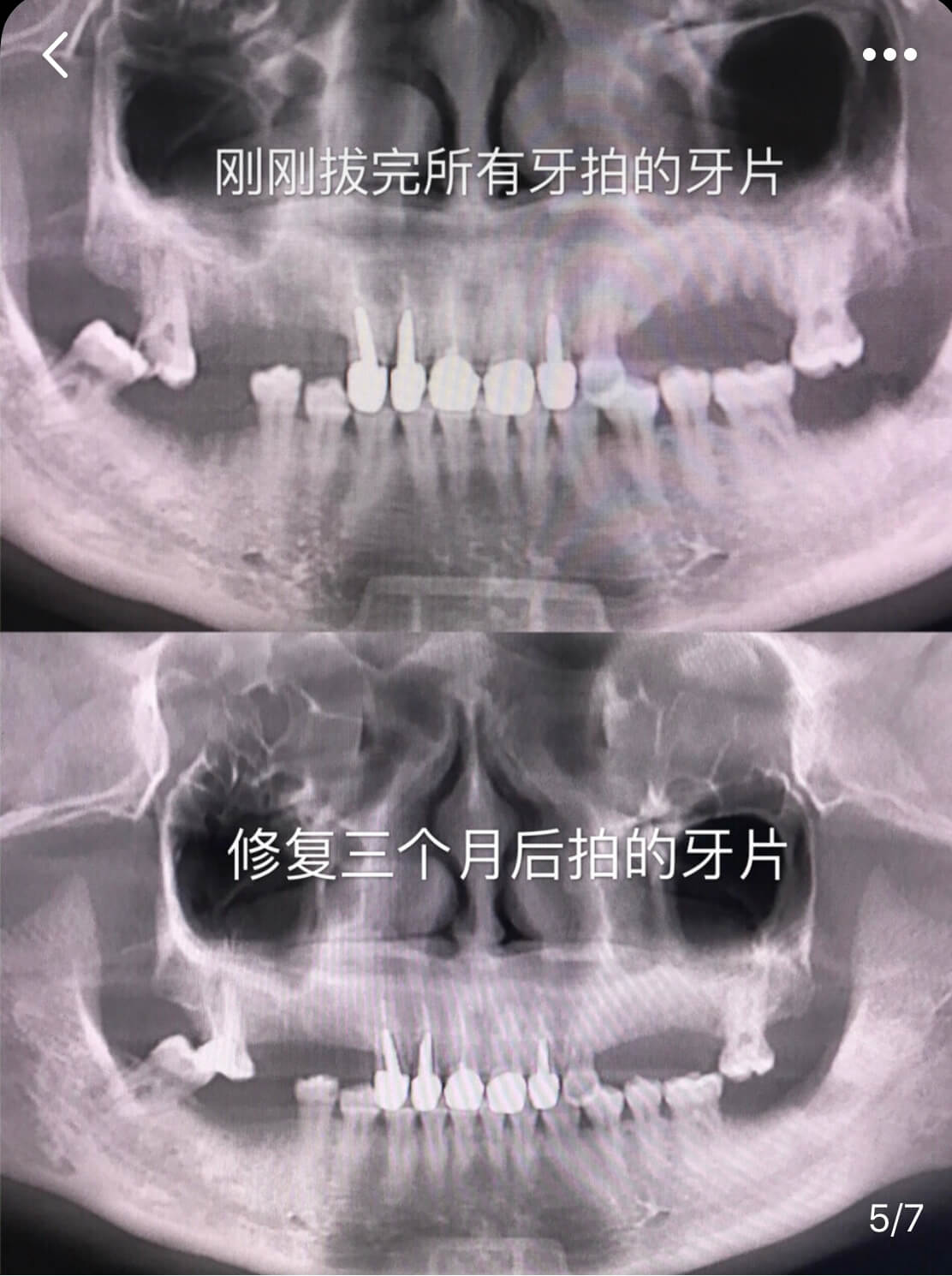 烤瓷牙會唔會斷