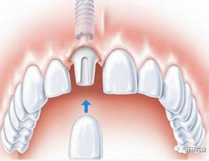 植牙嘅修復