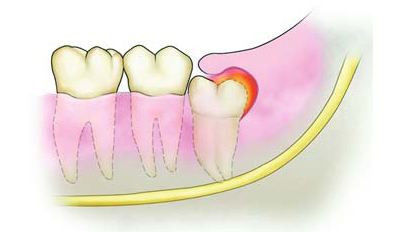 智齒冠周炎嘅病因及症狀