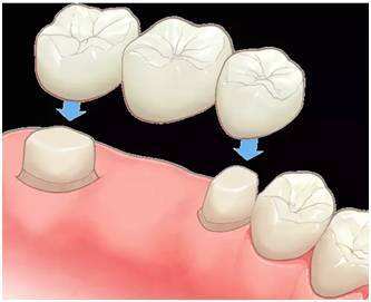 門牙缺失治療方式