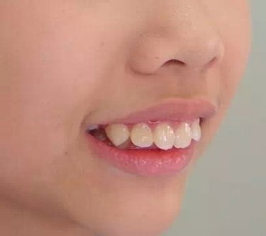 牙齒前突原因系乜