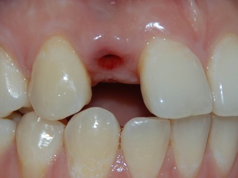 前牙種植成功案例