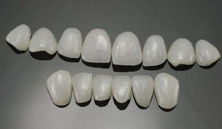 牙貼面種類