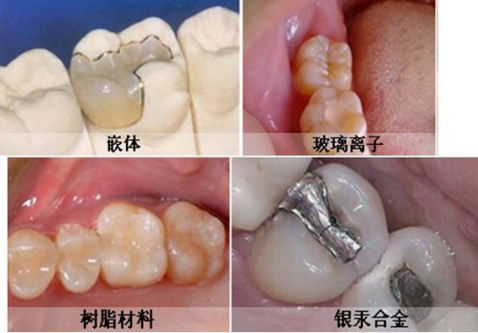 補牙洞一般都用乜材料？