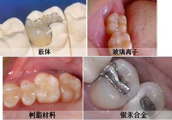 常見嘅補牙材料