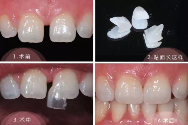 牙貼面同烤瓷牙區別