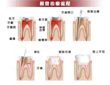 杜牙根嘅治疗步骤你知几多？