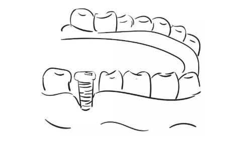 種植牙嘅全過程