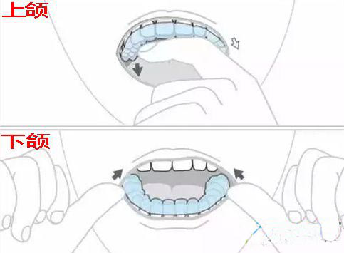 正確摘戴隱形牙套