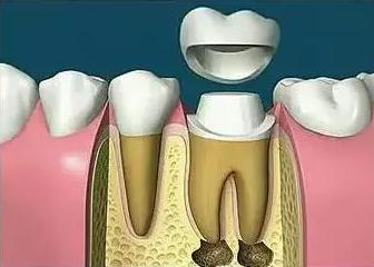 牙痛後點解醫生建議你杜牙根而唔系補牙