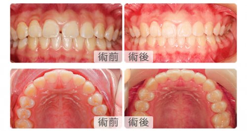 16歲深覆合深圳維港隱形矯正案例